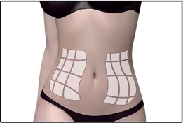 Écran de l'interface HIFU LIFT : quadrillage de l'abdomen