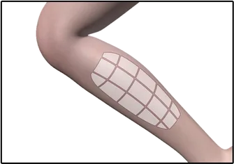 Interface HIFU LIFT : quadrillage de la jambe